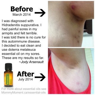 Healthy eating, essential oils and pictures of my disease – Hidradenitis suppurativa